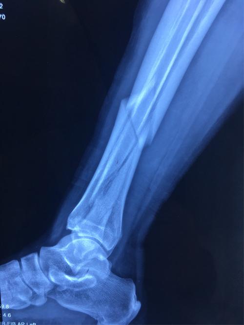 术前x线示右胫腓骨骨折