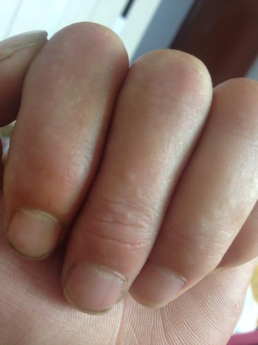 2014-04-19 郭棋勇 医师 我的手指表面长了两个疙瘩,有事痒搞破有水
