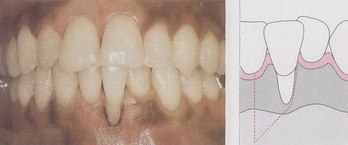 手术过程-美容牙科学-医学