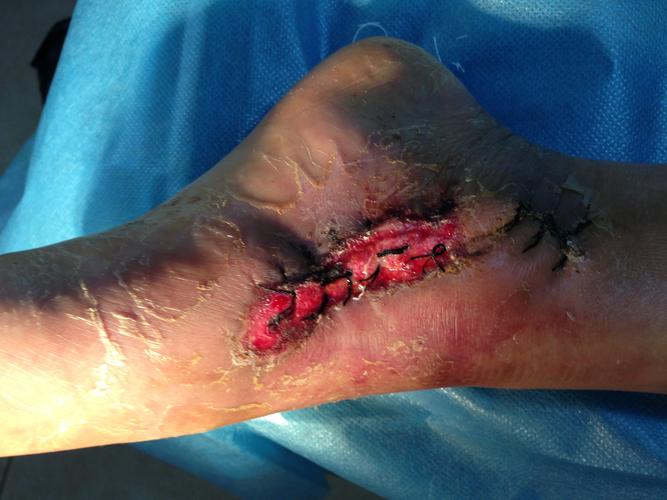 左内踝挫裂伤清创缝合术后伤口感染2周