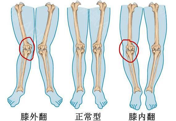 膝关节前交叉韧带撕裂不可忽视,得尽快治疗!
