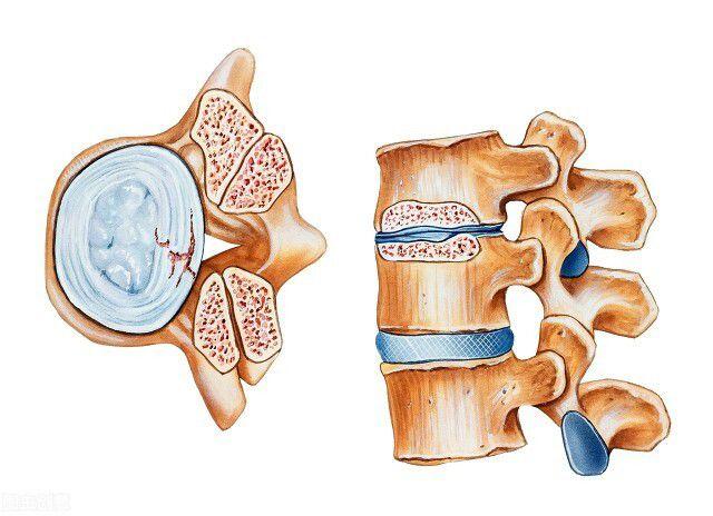 间隙狭窄,黄韧带肥厚,椎体后缘和椎间关节的骨质增生都可造成椎管变小