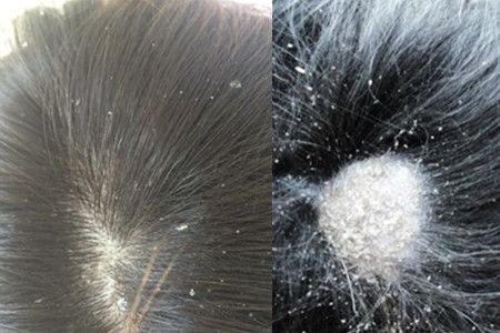 头皮干燥头屑多怎么办成热议话题 几个措施让你拥有丝滑秀发