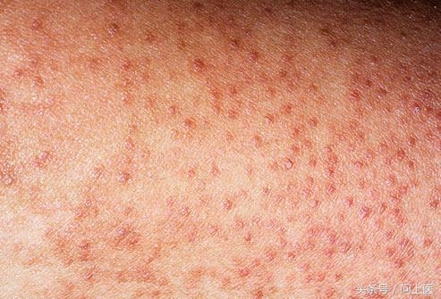 如果臀部和大腿上出现粗糙,痤疮样皮肤斑块,则可能是毛周角化病,这