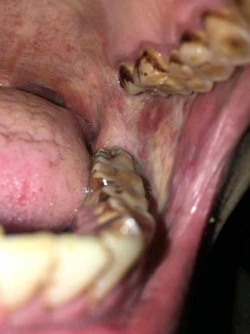 长期嚼槟榔需警惕可能导致口腔癌