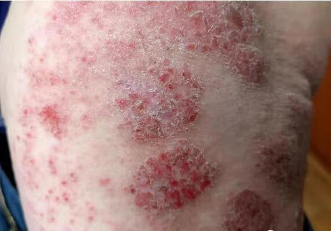 湿疹是临床常见的皮肤病,主要症状为瘙痒,很多患者总忍不住挠抓,往往