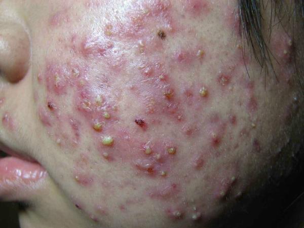 油性痘痘皮肤是夏季最受困扰的皮肤类型,皮肤油腻,不透气,容易花妆也