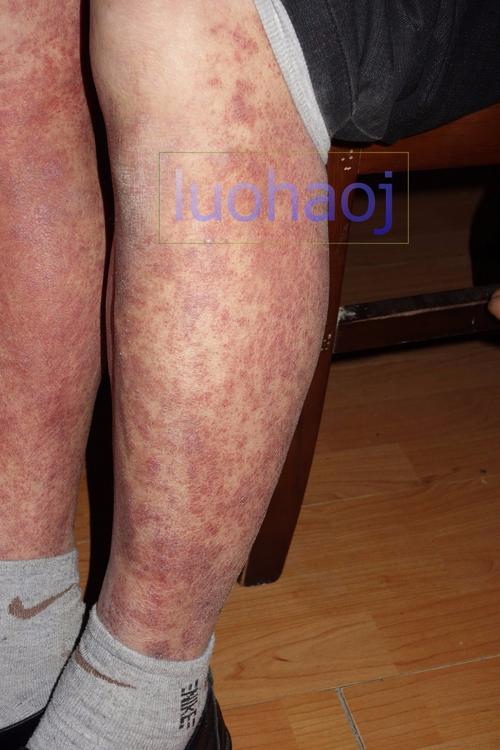 严重的双下肢小腿对称性色素紫癜样皮炎中西结合治疗医案