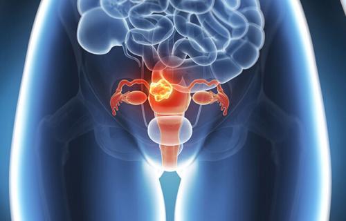 研究人员确定了34种与卵巢癌风险增加相关的基因