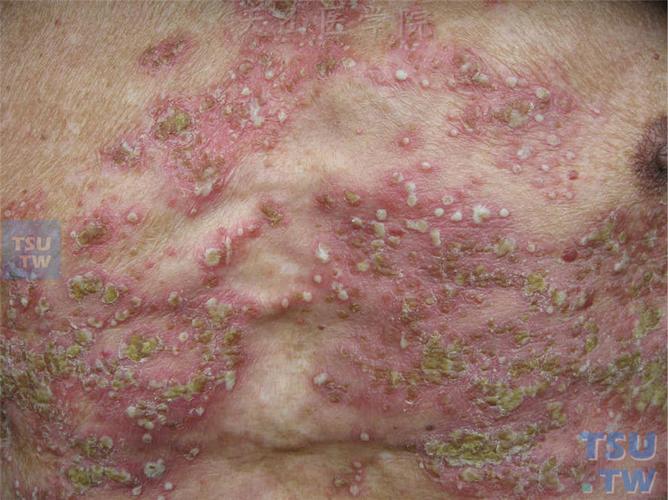 脓疱型银屑病(psoriasis pustulosa)的症状表现 - 皮肤病学 - 天山
