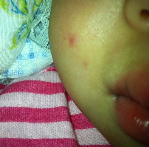 宝宝脸上这一块红疙瘩,疑似虫子叮咬的.