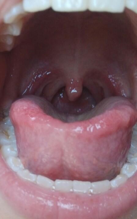 请医生看一下我的小舌头 最近感觉痰很多老是咳嗽 嗓子有异物感 听说