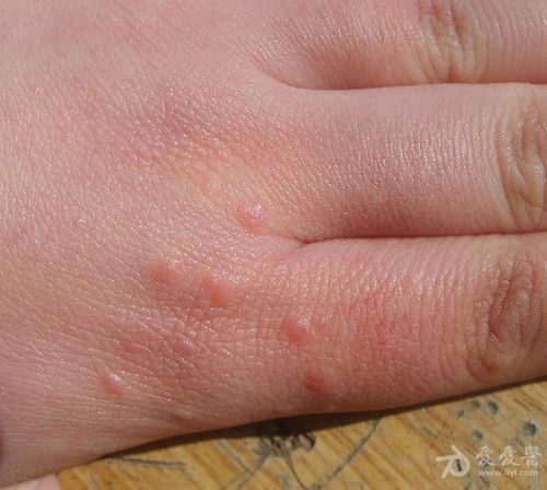手背的丘疹——疣状肢端角化病