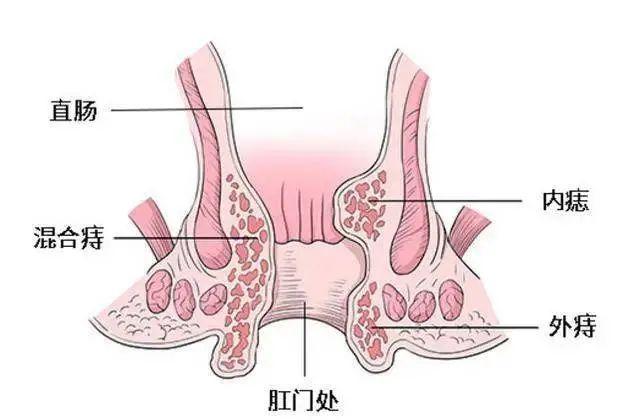 这是常见的肛周肿物疾病,生长在肛门齿状线以下,是由肛周静脉曲张从而
