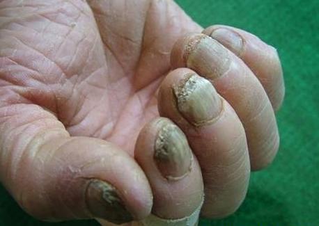 灰指甲案例症状图片