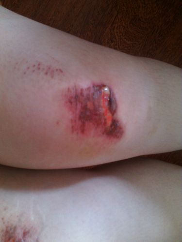 我腿在三天前摔伤我一直用双氧水擦伤口好像有一点化脓了请