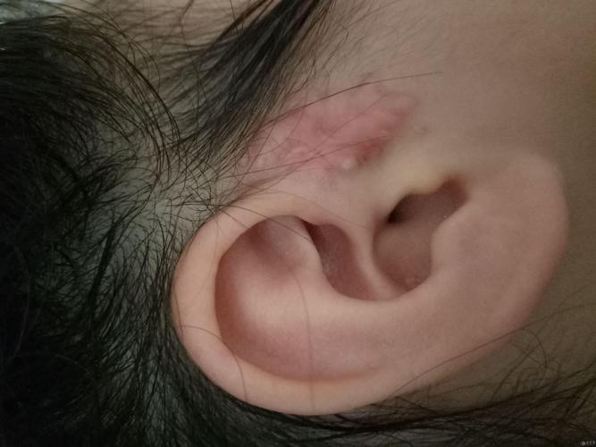 耳前瘘管手术后有疤痕怎么办