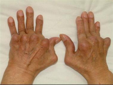 类风湿关节炎患者会出现手指变形由于病情发展至晚期,伸肌腱鞘炎症的