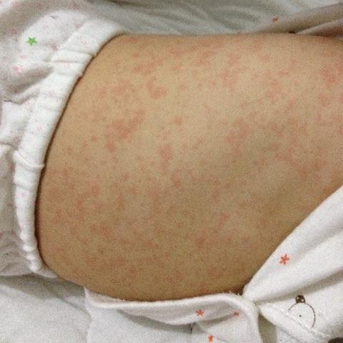 症状像感冒其实宝宝是出疹子 发烧前三天先别