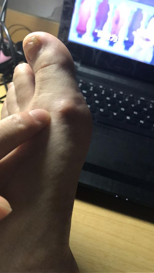 左脚拇指趾骨处有个突出的疙瘩,右脚没有,最近突然发现,不明白是何时