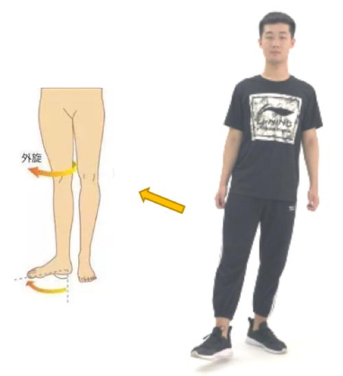 股骨外旋,使得下肢整体向外旋转,足踝关节也不例外,并且股骨外旋常常