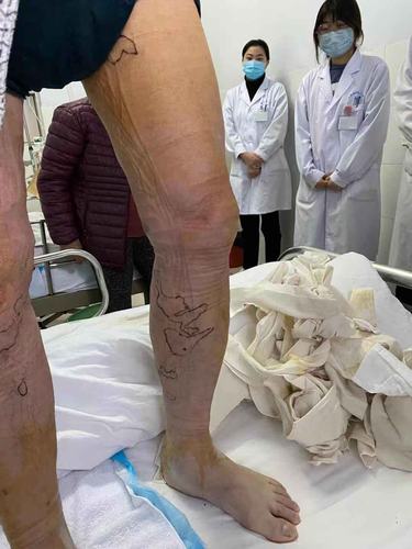 许昌市中心医院整合后的血管外科成功开展首例下肢静脉腔内微波消融