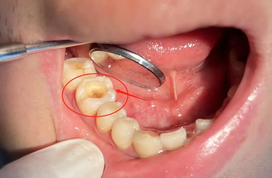 蛀牙.请注意!补牙并不是随便填洞,不仅仅是填一块材料把洞塞 - 抖音