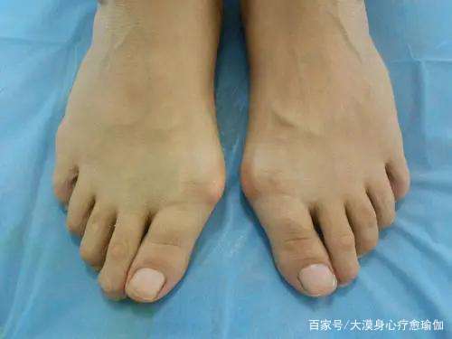 大脚趾外翻走路时脚趾疼痛小腿外翻假胯宽四个姿势帮你改善