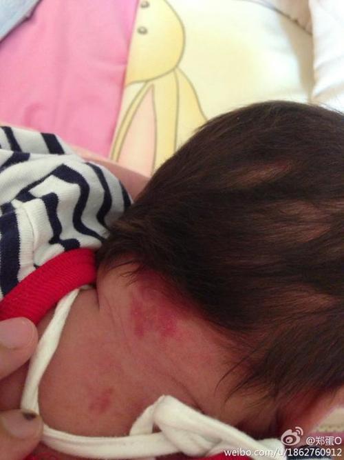 我家宝宝出生一个多月,她脖子后面有块红色胎记 爱问知识人