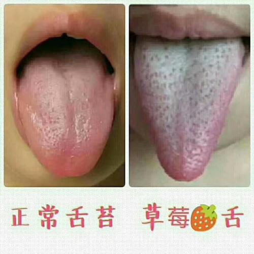 舌体瘦长,舌尖瘦小,舌质红,舌苔上布满了一颗一颗的鲜红的草莓点