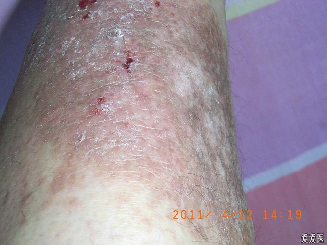 6年前7月左小腿前部出现一簇红疹瘙痒,逐渐成为癣块