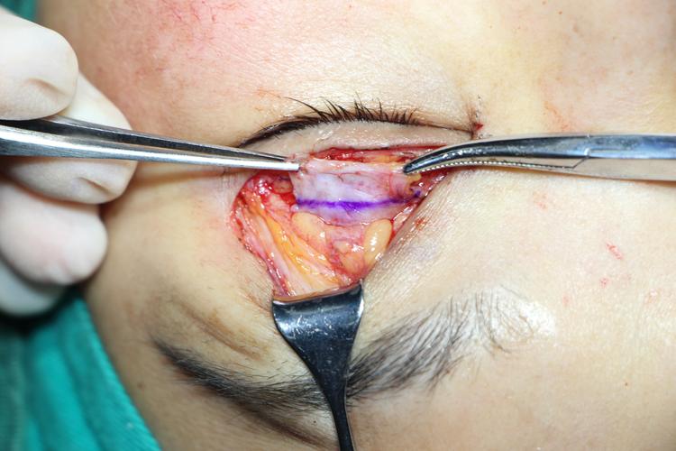 掌管睁眼的是上眼睑里面的一束肌肉叫做"提上睑肌",如下图手术钳拎起