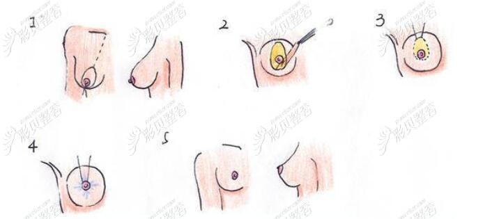 乳房双环提升手术步骤图解