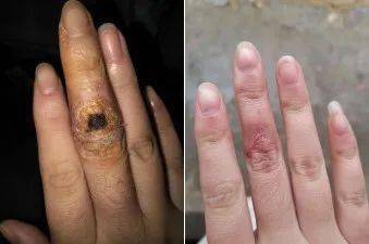 浙江19岁姑娘被虾刺了一下,手指红肿溃烂,20多天没愈合.
