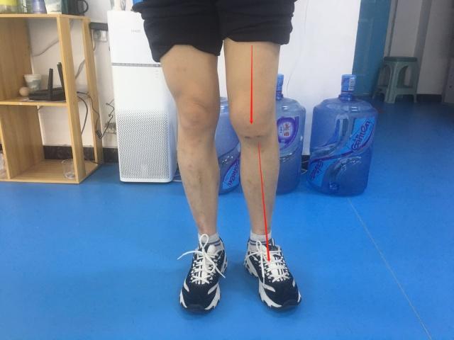 术后胫骨外翻(也称x型腿)的纠正与治疗(附动作视频)