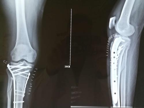 男性患者杨某,右侧胫骨近端骨折内固定术后2余年.