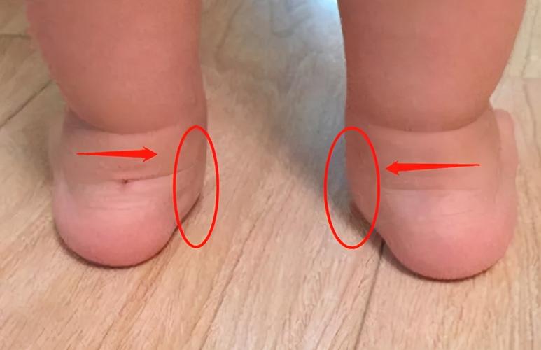 足外翻会让宝宝的脚部容易疲劳,也会引起脚部疼痛,也