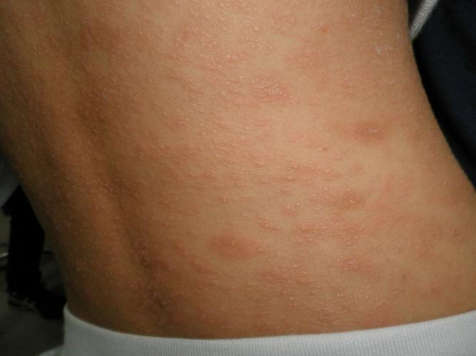 二期梅毒躯干部皮损,和玫瑰糠疹无法区别,可见检查对于防止误诊很重要