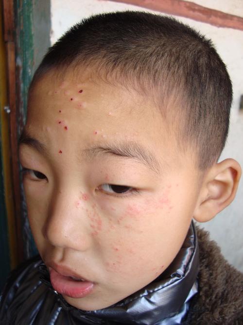 儿童面部张红疹,具体见图,求诊断,以及对策