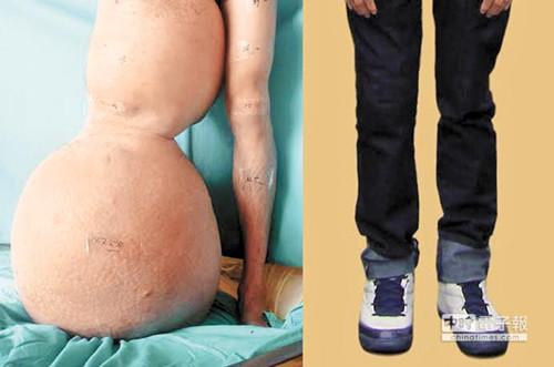 印尼男子患水肿腿围1.42米 赴台求医恢复修长双腿