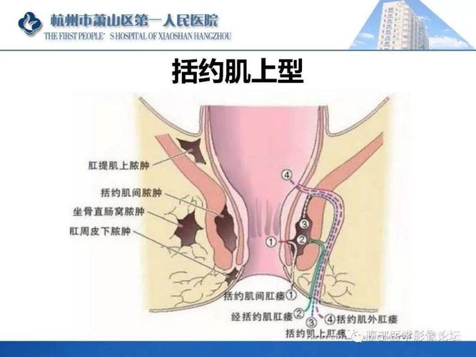 肛瘘又称"肛门直肠瘘",大部分肛瘘由肛门直肠脓肿破溃或切开排脓后