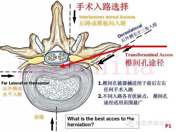 该技术通过特殊的外侧椎间孔入路途径,在内窥镜监视下摘除椎间盘突出