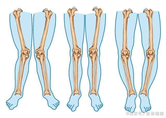 膎绳肌和胫骨旋转相关,股二头肌附着在胫骨的外侧髁,收缩时,胫骨外旋