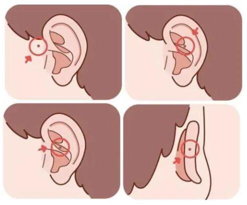 成都民生耳鼻喉提醒耳朵上有小洞不要挤这可能是耳前瘘管