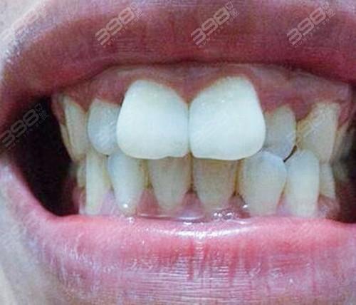 医生答疑:如果只是门牙突出,可以选择烤瓷牙冠的方式,也就是把牙齿磨
