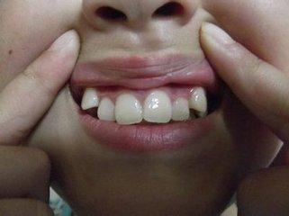 上海美奥口腔 口腔正畸 牙齿不齐 > 上海牙科儿童虎牙可以矫正吗?