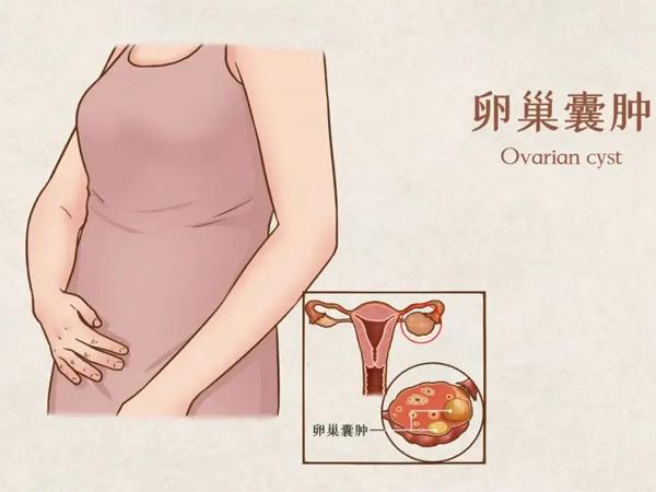 大多数患者的卵巢囊肿可自行消失,不会对人体造成损害.