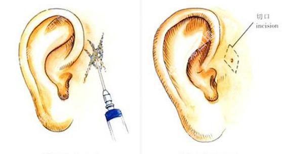 耳前瘘管的最佳治疗方法