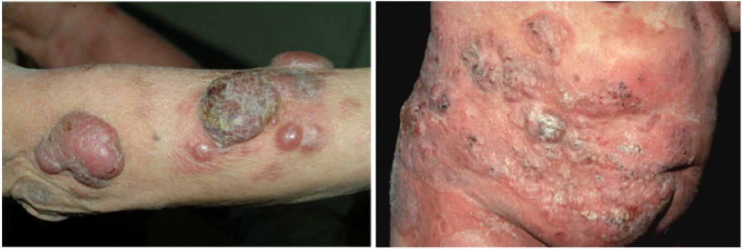 什么样的皮疹需要考虑皮肤淋巴瘤?