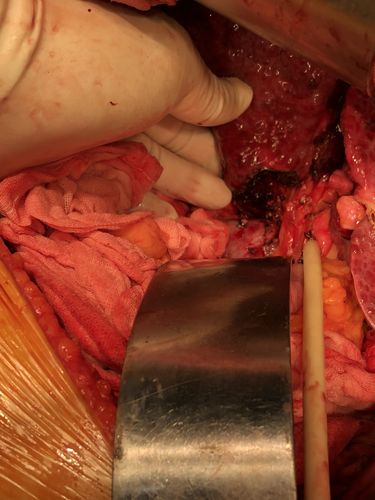 肝移植术后发生了胆道并发症怎么办